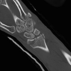 Radiocarpal Dislocation CT 3